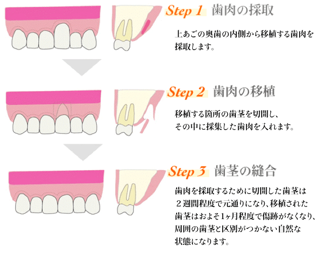 上あごの奥歯の内側から移植する歯肉  を採取します。    移植する箇所の歯茎を切開し、その中  に採集した歯肉を入れます。    歯肉を採取するために切開した歯茎は  ２週間程度で回復し、移植され た歯茎はおよそ1ヶ月程度で傷跡が目立たなくなり、周囲の歯茎と区別がつきにくい自然な状態になります。